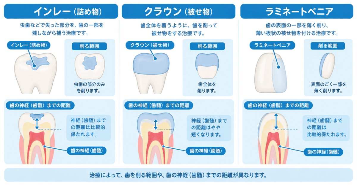セラミック治療で歯を削る量と神経への影響、ほかの治療の選択肢